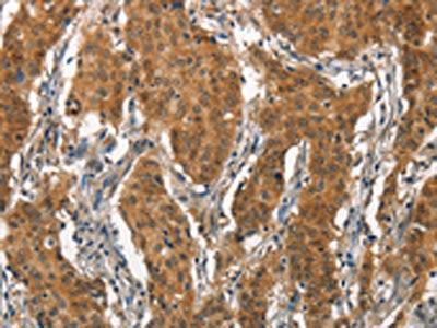 The image on the left is immunohistochemistry of paraffin-embedded Human gastic cancer tissue using CSB-PA938467(ITGA2 Antibody) at dilution 1/15, on the right is treated with synthetic peptide. (Original magnification: ×200)