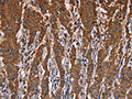The image on the left is immunohistochemistry of paraffin-embedded Human gastic cancer tissue using CSB-PA938525(LAMP2 Antibody) at dilution 1/40, on the right is treated with fusion protein. (Original magnification: ×200)