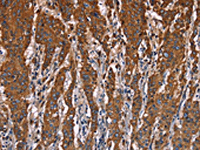 The image on the left is immunohistochemistry of paraffin-embedded Human gastic cancer tissue using CSB-PA938525(LAMP2 Antibody) at dilution 1/40, on the right is treated with fusion protein. (Original magnification: ×200)