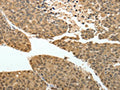 The image on the left is immunohistochemistry of paraffin-embedded Human liver cancer tissue using CSB-PA938686(PSMD3 Antibody) at dilution 1/30, on the right is treated with fusion protein. (Original magnification: ×200)