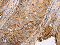The image on the left is immunohistochemistry of paraffin-embedded Human cervical cancer tissue using CSB-PA938817(pan CDH Antibody) at dilution 1/20, on the right is treated with synthetic peptide. (Original magnification: ×200)