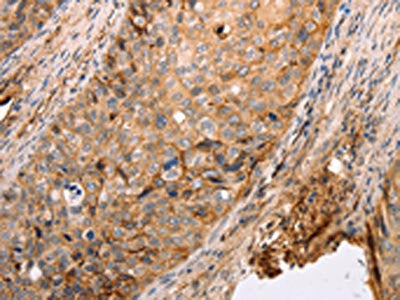The image on the left is immunohistochemistry of paraffin-embedded Human cervical cancer tissue using CSB-PA938817(pan CDH Antibody) at dilution 1/20, on the right is treated with synthetic peptide. (Original magnification: ×200)