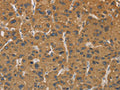 The image on the left is immunohistochemistry of paraffin-embedded Human liver cancer tissue using CSB-PA939101(CYP17A1 Antibody) at dilution 1/30, on the right is treated with fusion protein. (Original magnification: ×200)