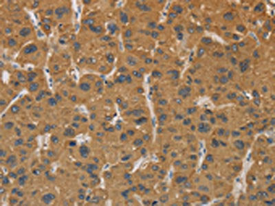 The image on the left is immunohistochemistry of paraffin-embedded Human liver cancer tissue using CSB-PA939101(CYP17A1 Antibody) at dilution 1/30, on the right is treated with fusion protein. (Original magnification: ×200)