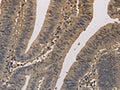 The image on the left is immunohistochemistry of paraffin-embedded Human colon cancer tissue using CSB-PA939360(ELOVL1 Antibody) at dilution 1/50, on the right is treated with fusion protein. (Original magnification: ×200)