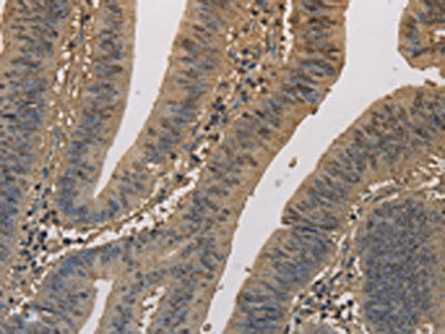The image on the left is immunohistochemistry of paraffin-embedded Human colon cancer tissue using CSB-PA939360(ELOVL1 Antibody) at dilution 1/50, on the right is treated with fusion protein. (Original magnification: ×200)