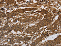 The image on the left is immunohistochemistry of paraffin-embedded Human gastic cancer tissue using CSB-PA939542(ITGB7 Antibody) at dilution 1/30, on the right is treated with synthetic peptide. (Original magnification: ×200)