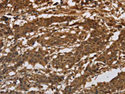 The image on the left is immunohistochemistry of paraffin-embedded Human gastic cancer tissue using CSB-PA939542(ITGB7 Antibody) at dilution 1/30, on the right is treated with synthetic peptide. (Original magnification: ×200)