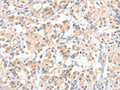 The image on the left is immunohistochemistry of paraffin-embedded Human thyroid cancer tissue using CSB-PA939596(CLIP1 Antibody) at dilution 1/30, on the right is treated with fusion protein. (Original magnification: ×200)