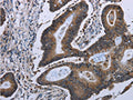 The image on the left is immunohistochemistry of paraffin-embedded Human colon cancer tissue using CSB-PA939663(ITGAE Antibody) at dilution 1/50, on the right is treated with fusion protein. (Original magnification: ×200)