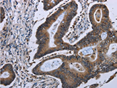 The image on the left is immunohistochemistry of paraffin-embedded Human colon cancer tissue using CSB-PA939663(ITGAE Antibody) at dilution 1/50, on the right is treated with fusion protein. (Original magnification: ×200)