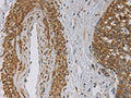The image on the left is immunohistochemistry of paraffin-embedded Human cervical cancer tissue using CSB-PA939763(EMC8 Antibody) at dilution 1/30, on the right is treated with fusion protein. (Original magnification: ×200)
