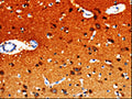 The image on the left is immunohistochemistry of paraffin-embedded Human brain tissue using CSB-PA939836(GDI1 Antibody) at dilution 1/20, on the right is treated with fusion protein. (Original magnification: ×200)