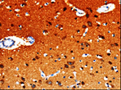 The image on the left is immunohistochemistry of paraffin-embedded Human brain tissue using CSB-PA939836(GDI1 Antibody) at dilution 1/20, on the right is treated with fusion protein. (Original magnification: ×200)