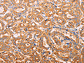 The image on the left is immunohistochemistry of paraffin-embedded Human thyroid cancer tissue using CSB-PA940023(ADH1B Antibody) at dilution 1/60, on the right is treated with synthetic peptide. (Original magnification: ×200)