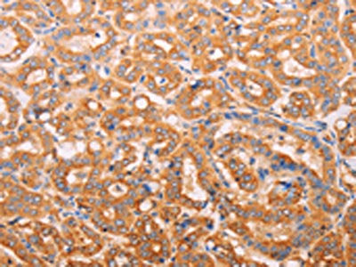 The image on the left is immunohistochemistry of paraffin-embedded Human thyroid cancer tissue using CSB-PA940023(ADH1B Antibody) at dilution 1/60, on the right is treated with synthetic peptide. (Original magnification: ×200)