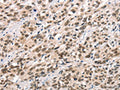 The image on the left is immunohistochemistry of paraffin-embedded Human esophagus cancer tissue using CSB-PA940399(CCNT1 Antibody) at dilution 1/20, on the right is treated with synthetic peptide. (Original magnification: ×200)