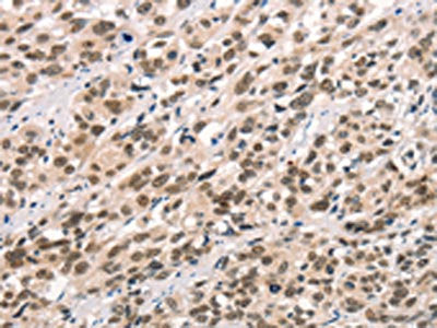 The image on the left is immunohistochemistry of paraffin-embedded Human esophagus cancer tissue using CSB-PA940399(CCNT1 Antibody) at dilution 1/20, on the right is treated with synthetic peptide. (Original magnification: ×200)