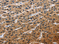 The image on the left is immunohistochemistry of paraffin-embedded Human liver cancer tissue using CSB-PA940544(EIF4EBP2 Antibody) at dilution 1/40, on the right is treated with fusion protein. (Original magnification: ×200)