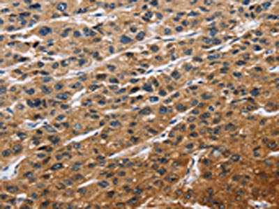 The image on the left is immunohistochemistry of paraffin-embedded Human liver cancer tissue using CSB-PA940544(EIF4EBP2 Antibody) at dilution 1/40, on the right is treated with fusion protein. (Original magnification: ×200)
