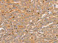 The image on the left is immunohistochemistry of paraffin-embedded Human thyroid cancer tissue using CSB-PA940582(CCL16  Antibody) at dilution 1/60, on the right is treated with synthetic peptide. (Original magnification: ×200)