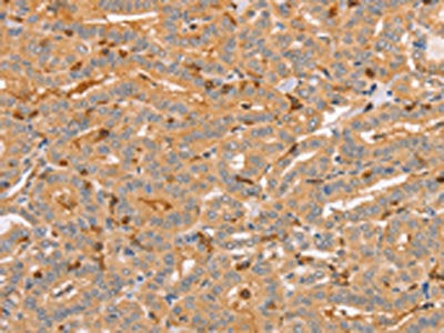 The image on the left is immunohistochemistry of paraffin-embedded Human thyroid cancer tissue using CSB-PA940582(CCL16  Antibody) at dilution 1/60, on the right is treated with synthetic peptide. (Original magnification: ×200)