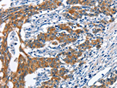 The image on the left is immunohistochemistry of paraffin-embedded Human gastic cancer tissue using CSB-PA940735(MMP2 Antibody) at dilution 1/60, on the right is treated with synthetic peptide. (Original magnification: ×200)