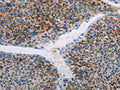 The image on the left is immunohistochemistry of paraffin-embedded Human liver cancer tissue using CSB-PA940902(AMOTL2 Antibody) at dilution 1/20, on the right is treated with fusion protein. (Original magnification: ×200)