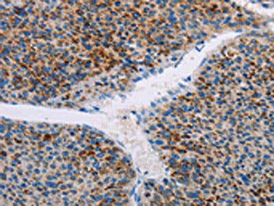The image on the left is immunohistochemistry of paraffin-embedded Human liver cancer tissue using CSB-PA940902(AMOTL2 Antibody) at dilution 1/20, on the right is treated with fusion protein. (Original magnification: ×200)