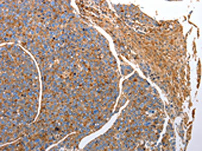 The image on the left is immunohistochemistry of paraffin-embedded Human liver cancer tissue using CSB-PA940948(CD151 Antibody) at dilution 1/25, on the right is treated with fusion protein. (Original magnification: ×200)