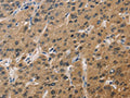 The image on the left is immunohistochemistry of paraffin-embedded Human liver cancer tissue using CSB-PA940977(DUSP26 Antibody) at dilution 1/60, on the right is treated with fusion protein. (Original magnification: ×200)
