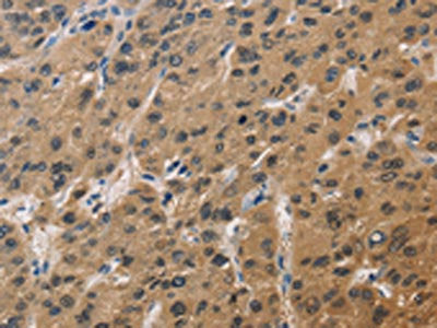 The image on the left is immunohistochemistry of paraffin-embedded Human liver cancer tissue using CSB-PA940977(DUSP26 Antibody) at dilution 1/60, on the right is treated with fusion protein. (Original magnification: ×200)