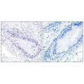 Immunohistochemistry analysis of paraffin-embedded human lung carcinoma tissue, using TEP1 antibody.