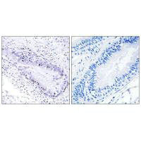 Immunohistochemistry analysis of paraffin-embedded human lung carcinoma tissue, using TEP1 antibody.