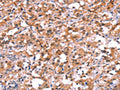 The image on the left is immunohistochemistry of paraffin-embedded Human thyroid cancer tissue using CSB-PA941444(BCAR1 Antibody) at dilution 1/15, on the right is treated with synthetic peptide. (Original magnification: ×200)