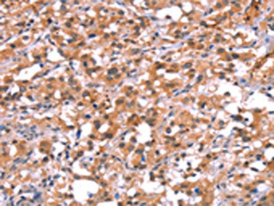 The image on the left is immunohistochemistry of paraffin-embedded Human thyroid cancer tissue using CSB-PA941444(BCAR1 Antibody) at dilution 1/15, on the right is treated with synthetic peptide. (Original magnification: ×200)