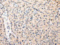 The image on the left is immunohistochemistry of paraffin-embedded Human liver cancer tissue using CSB-PA941558(MUC1(NT) Antibody) at dilution 1/35, on the right is treated with synthetic peptide. (Original magnification: ×200)