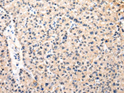 The image on the left is immunohistochemistry of paraffin-embedded Human liver cancer tissue using CSB-PA941558(MUC1(NT) Antibody) at dilution 1/35, on the right is treated with synthetic peptide. (Original magnification: ×200)