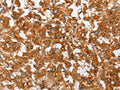 The image on the left is immunohistochemistry of paraffin-embedded Human thyroid cancer tissue using CSB-PA941696(PLA2G4A Antibody) at dilution 1/50, on the right is treated with fusion protein. (Original magnification: ×200)