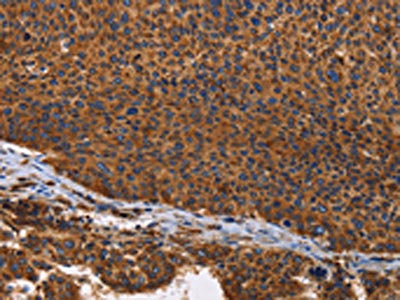The image on the left is immunohistochemistry of paraffin-embedded Human liver cancer tissue using CSB-PA941698(ILK Antibody) at dilution 1/60, on the right is treated with fusion protein. (Original magnification: ×200)