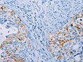 The image on the left is immunohistochemistry of paraffin-embedded Human cervical cancer tissue using CSB-PA941852(CA10 Antibody) at dilution 1/35, on the right is treated with fusion protein. (Original magnification: ×200)