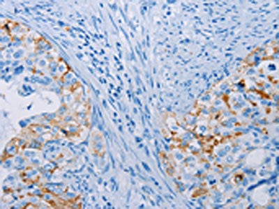 The image on the left is immunohistochemistry of paraffin-embedded Human cervical cancer tissue using CSB-PA941852(CA10 Antibody) at dilution 1/35, on the right is treated with fusion protein. (Original magnification: ×200)