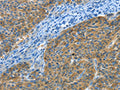 The image on the left is immunohistochemistry of paraffin-embedded Human liver cancer tissue using CSB-PA942155(BIN1 Antibody) at dilution 1/30, on the right is treated with fusion protein. (Original magnification: ×200)