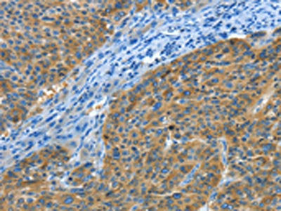 The image on the left is immunohistochemistry of paraffin-embedded Human liver cancer tissue using CSB-PA942155(BIN1 Antibody) at dilution 1/30, on the right is treated with fusion protein. (Original magnification: ×200)