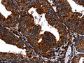 The image on the left is immunohistochemistry of paraffin-embedded Human cervical cancer tissue using CSB-PA942209(EGF Antibody) at dilution 1/60, on the right is treated with fusion protein. (Original magnification: ×200)