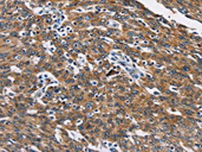 The image on the left is immunohistochemistry of paraffin-embedded Human ovarian cancer tissue using CSB-PA942303(CAT Antibody) at dilution 1/40, on the right is treated with fusion protein. (Original magnification: ×200)