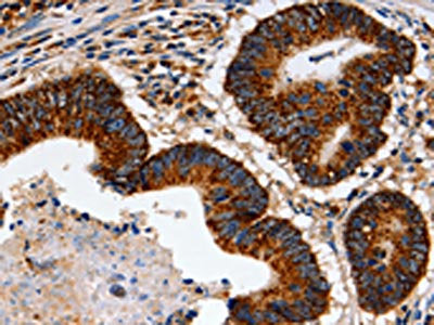 The image on the left is immunohistochemistry of paraffin-embedded Human colon cancer tissue using CSB-PA942344(TRAP1 Antibody) at dilution 1/60, on the right is treated with fusion protein. (Original magnification: ×200)