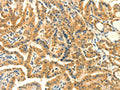 The image on the left is immunohistochemistry of paraffin-embedded Human thyroid cancer tissue using CSB-PA942370(PRKACG Antibody) at dilution 1/25, on the right is treated with fusion protein. (Original magnification: ×200)