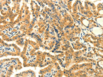 The image on the left is immunohistochemistry of paraffin-embedded Human thyroid cancer tissue using CSB-PA942370(PRKACG Antibody) at dilution 1/25, on the right is treated with fusion protein. (Original magnification: ×200)