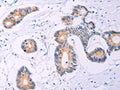 The image on the left is immunohistochemistry of paraffin-embedded Human colon cancer tissue using CSB-PA942397(ADCY5 Antibody) at dilution 1/30, on the right is treated with synthetic peptide. (Original magnification: ×200)